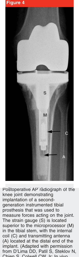 Same article — Figure 4: postoperative AP radiograph of an instrumented tibial prosthesis. Coil and antenna labeled.