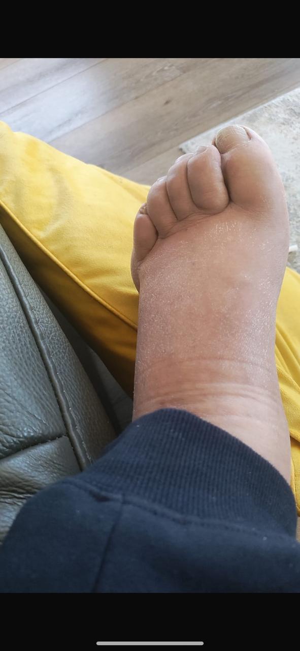 Another still of a swollen foot, yellow cushion.