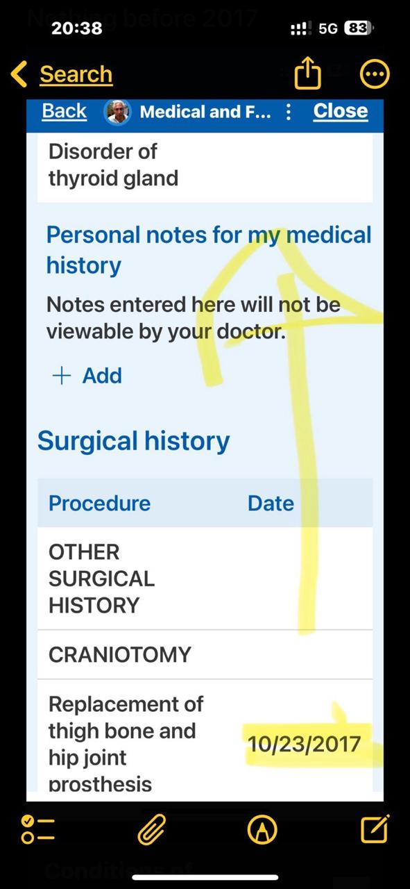 Surgical history — Replacement of thigh bone and hip joint prosthesis 10/23/2017