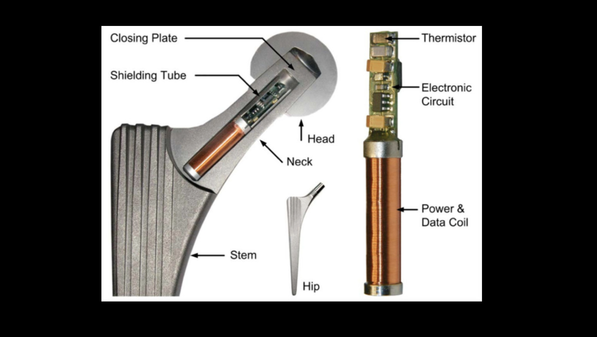 Bergmann OrthoLoad cutaway — thermistor, electronic circuit, and a power-and-data coil in the neck. Inductive. Not a phone.